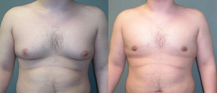 ژنیکوماستی یا کوچک کردن سینه در مردان